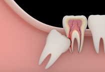Những Nguy Hiểm Tiềm Ẩn Của Răng Khôn: Đừng Đợi Đến Khi Đau Mới Điều Trị