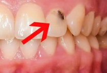 Sâu răng dấu hiệu và cách điều trị 