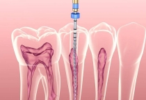 Sợ Chữa Tủy Vì Đau? Sự Thật Về Điều Trị Tủy Răng Bạn Nên Biết