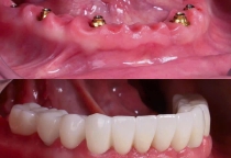 Cấy ghép Implant 