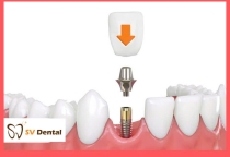 Trồng răng Implant thay thế một vài răng- Nha khoa SV quận 3