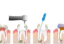 Điều trị tủy răng và những thông tin hữu ích bạn cần biết ?