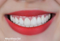 Địa chỉ làm răng dán sứ đẹp uy tín tại Hồ Chí Minh – Nha Khoa SV