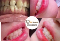 Răng sứ có hôi miệng không ? giáp đáp từ bác sĩ NHA KHOA SV, quận 3 