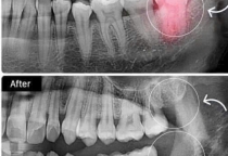 Nhổ  răng khôn có đau không ? giải đáp chi tiết từ BS NHA KHOA SV