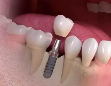 BẢNG GIÁ IMPLANT 