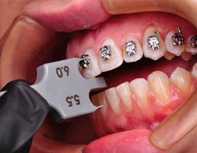 Niềng răng thẩm mỹ 