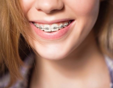 Niềng Răng Bao Lâu? 7 Yếu Tố Quyết Định Thời Gian Chỉnh Nha