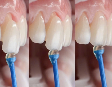 Ưu điểm và khuyết điểm mặt dán sứ  Veneer tại NHA KHOA SV, Quận 3 
