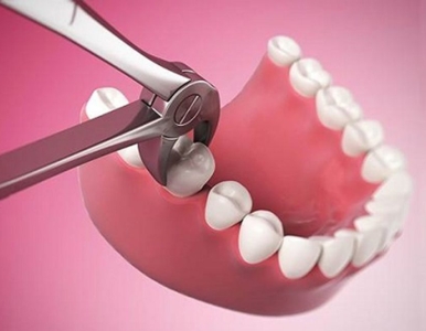 NHỔ RĂNG VÀ NHỮNG ĐIỀU CẦN BIẾT?