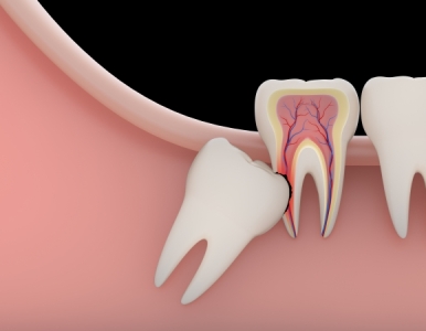 Những Nguy Hiểm Tiềm Ẩn Của Răng Khôn: Đừng Đợi Đến Khi Đau Mới Điều Trị
