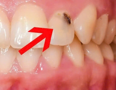 Sâu răng dấu hiệu và cách điều trị 