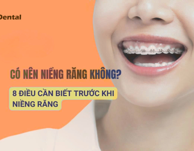 Có nên niềng răng không? 8 điều bạn nhất định phải biết trước khi niềng răng