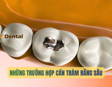 Răng sâu là gì? Khi nào nên trám răng sâu? Giải pháp phục hồi răng hiệu quả tại Nha Khoa SV
