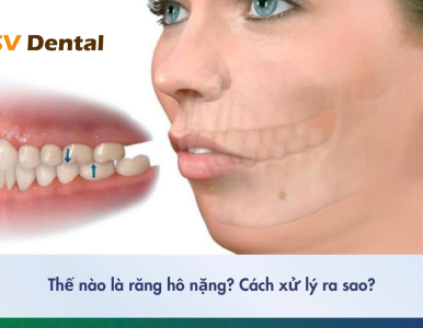 Răng hô nặng là như thế nào? Niềng răng hô nặng có hiệu quả không? [Giải đáp từ chuyên gia Nha Khoa SV]