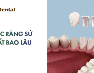 ⏱️ Bọc Răng Sứ Mất Bao Lâu? Quy Trình Làm Răng Sứ Nhanh Nhất Tại Nha Khoa SV