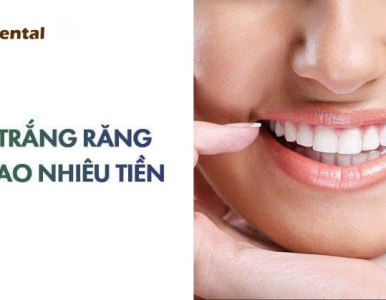 TẨY TRẮNG RĂNG GIÁ BAO NHIÊU TIỀN? BẢNG GIÁ TẨY TRẮNG RĂNG TẠI NHA KHOA SV MỚI NHẤT 2025