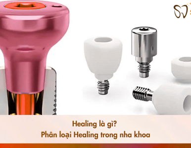 Healing là gì? Phân loại Healing trong nha khoa Implant tại nha khoa sv 