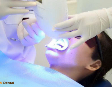 Có nên tẩy trắng răng gần Tết không? Giải đáp chi tiết từ Nha Khoa SV