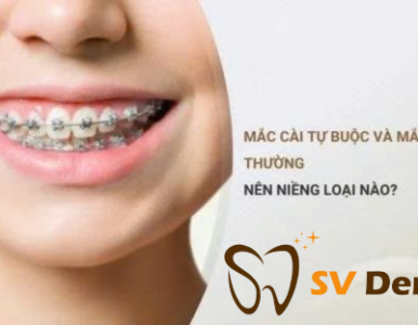 Mắc cài tự buộc và mắc cài thường: Nên chọn loại nào khi niềng răng? | Nha Khoa SV