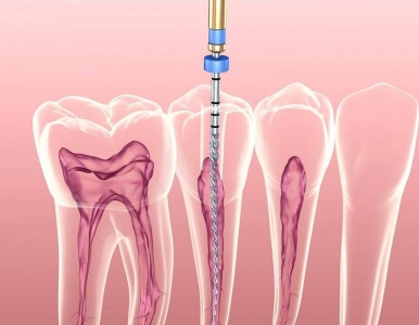 Sợ Chữa Tủy Vì Đau? Sự Thật Về Điều Trị Tủy Răng Bạn Nên Biết