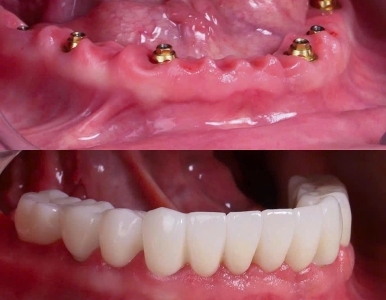Cấy ghép Implant 