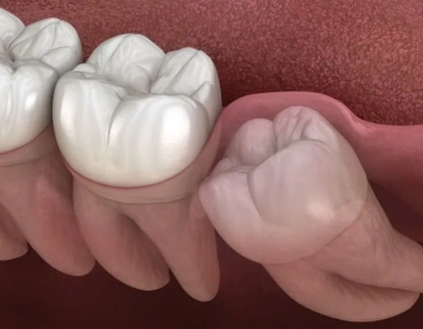 Cách giảm đau khi mọc răng khôn và chăm sóc sau tiểu phẫu tại NHA KHOA SV - QUẬN 3 