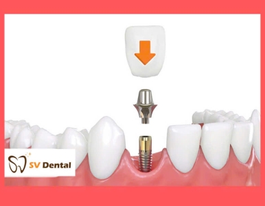 Trồng răng Implant thay thế một vài răng- Nha khoa SV quận 3