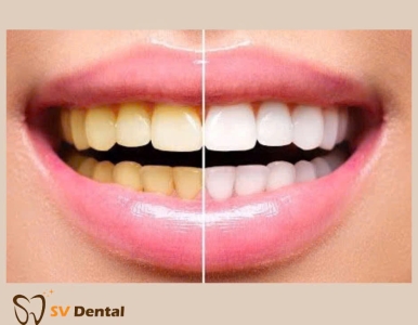 Tẩy trắng răng- Những điều cần lưu ý