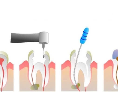 Điều trị tủy răng và những thông tin hữu ích bạn cần biết ?
