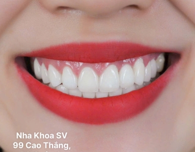 Răng sứ là gì > các loại răng sứ, quy trình bọc răng sứ tại nha khoa sv 