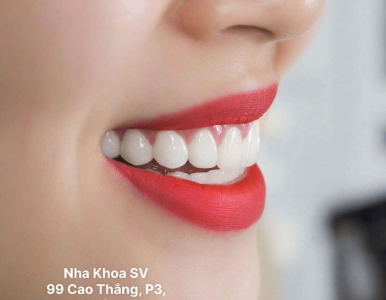 Dán răng sứ: Ưu điểm, nhược điểm và những điều cần biết trước khi thực hiện tại NHA KHOA SV 