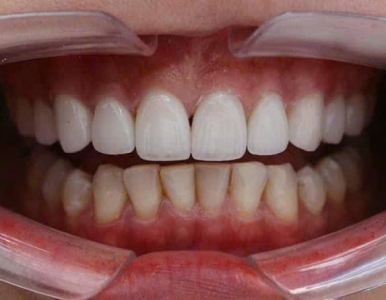 Dán sứ vernee ? thẩm mỹ đẹp, không đau tại Nha Khoa SV.