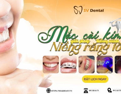 Niêng Răng Mắc Cài -Giải Pháp Hiệu Quả Tại Nha Khoa SV, Quận 3 