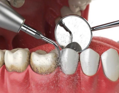 cạo vôi răng là gì ? quy trình và lợi ích của NHA KHOA SV 