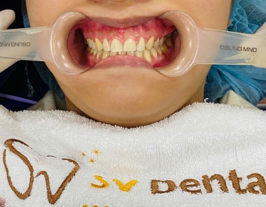 Niềng Răng Mắc Cài Là Gì? Quy Trình, Chi Phí Và Kinh Nghiệm Niềng Hiệu Quả Tại Nha Khoa SV