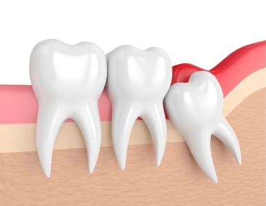 Nhổ răng khôn kiêng ăn gì? Danh sách thực phẩm cần tránh để mau lành thương cùng Nha Khoa SV 