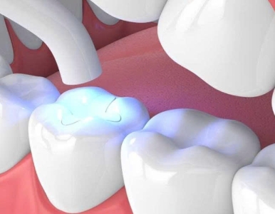 rám răng Inlay/Onlay sứ thẩm mỹ –  GIÁ DỊCH VỤ - 2.500.000- 6.000.000 / 1 ĐV RĂNG.tai NHA KHOA SV  XEM CHI TIẾT 