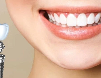 Quy trình cấy ghép Implant chuẩn nha khoa – Hiểu đúng để trồng răng an toàn, bền đẹp  NHA KHOA SV 