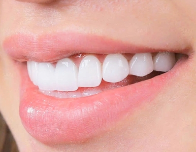  Bọc răng sứ không mài răng – An toàn, bền, đẹp & Giá bao nhiêu?