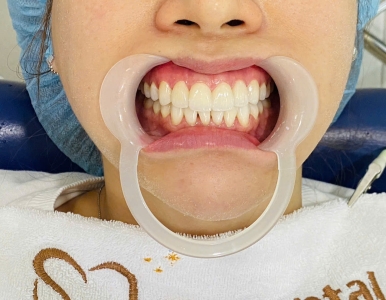 Dán sứ Veneer là gì? Giải pháp thẩm mỹ bảo tồn răng thật tối đa NHA KHOA SV 