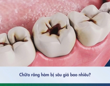 Chữa sâu răng hàm giá bao nhiêu tiền? Bảng giá chi tiết 2025 tại Nha Khoa SV
