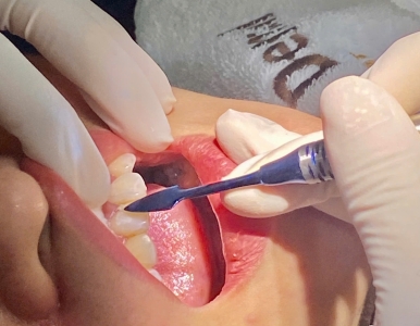 Trám Răng Sâu: Giải Pháp Hiệu Quả Bảo Vệ Sức Khỏe Răng Miệng tại NHA KHOA SV 