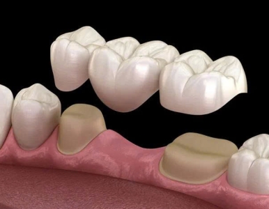 Cầu răng sứ là gì? Giải pháp phục hồi răng mất hiệu quả, an toàn tại Nha Khoa SV