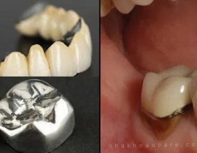 Bọc răng sứ kim loại: Giải pháp thẩm mỹ và tiết kiệm tại NHA KHOA SV 