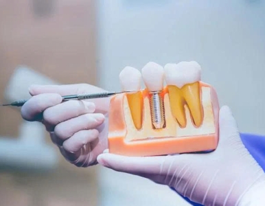 Tìm hiểu công nghệ trồng răng cấy ghép Implant – Giải pháp phục hồi răng mất bền vững tại NHA KHOA SV 