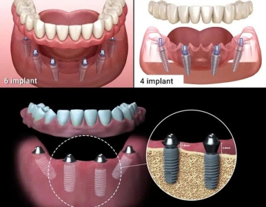 Cấy ghép Implant mất răng toàn hàm – Giải pháp phục hồi răng toàn diện, bền vững tại NHA KHOA SV 
