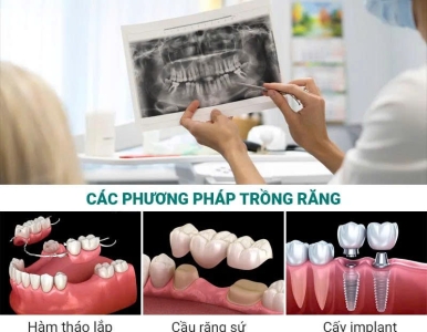 Trồng Răng Giả: Nên Chọn Hàm Tháo Lắp, Cầu Răng Hay Implant? tại NHA KHOA SV 