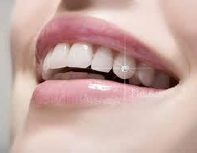 Đính Đá Lên Răng Là Gì? Quy Trình – Chi Phí – Lưu Ý Tại Nha Khoa SV