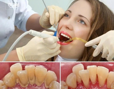 Điều Trị Viêm Nha Chu Hiệu Quả – Bảo Vệ Răng Chắc Khỏe Lâu Dài | Nha Khoa SV